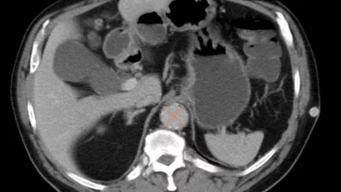 AI algorithm spots AAA on abdominal CT scan