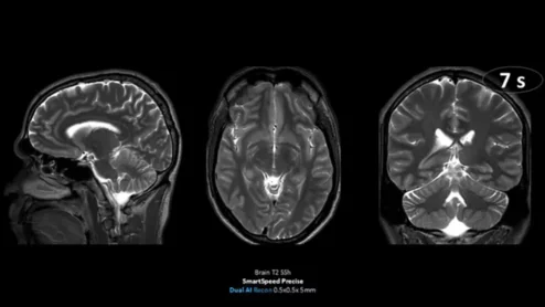 SmartSpeed Precision DL recon software earns FDA clearance