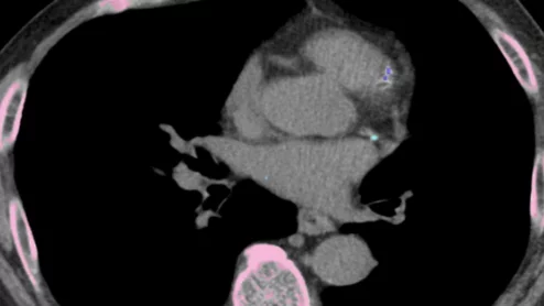 AI completes CAC assessment using routine LDCT scan