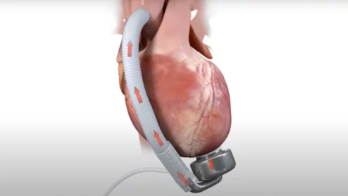 CorWave LVAD