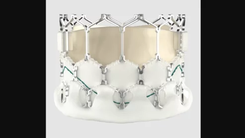 The balloon-expandable Myval transcatheter aortic valve replacement (TAVR) valve is associated with positive real-world data after four years.