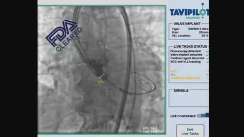 Caranx Medical TAVIPILOT