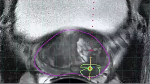 Philips UroNav system gains FDA clearance