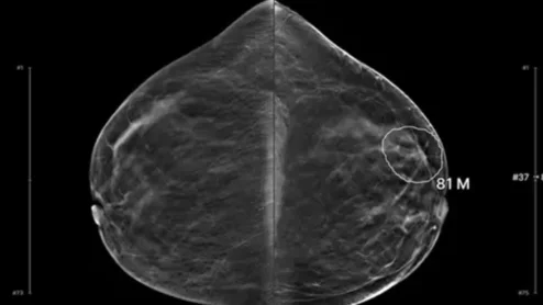 Lunit AI detects interval breast cancer missed by radiologists