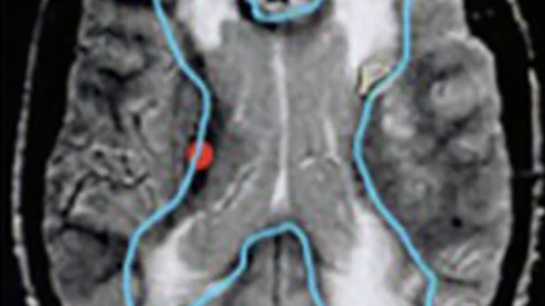 MRI biomarkers predict cognitive impairment post-stroke