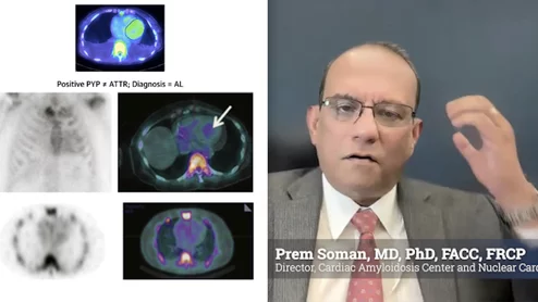 Prem Soman, MD, PhD, FACC, FRCP, past president of the American Society of Nuclear Cardiology (ASNC), the Richard S. Caligiuri Endowed Chair in Amyloidosis and Heart Failure, director of the Cardiac Amyloidosis Center, director of nuclear cardiology, and a professor of medicine, University of Pittsburgh Medical Center (UPMC) Heart and Vascular Institute. He is presenting the keynote Mario Verani Memorial Lecture at ASNC 2025, where he will discuss transforming cardiac amyloidosis care.