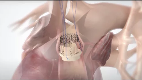Corcym’s Perceval Plus aortic heart valve 