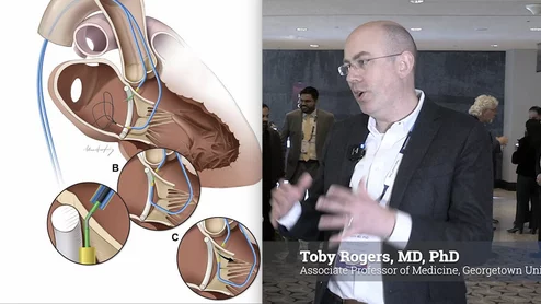 Toby Rogers, MD, PhD, associate professor of medicine Georgetown University, and interventional cardiologist at MedStar Heart and Vascular Institute Structural Heart Disease program, explains how the transcatheter electrosurgical procedures for transcaval access, SESAME, LAMPOON and BASILICA has helped large numbers of patients receive transcatheter heart valves who otherwise would have been disqualified due to anatomical issues. 