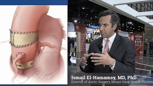Ismail El-Hamamsy, MD, PhD, director of aortic surgery for the Mount Sinai Health System, explains the long-term outcomes of the Ross procedure, where a diseased aortic valve is surgically replaced with the patient's own pulmonary valve. 
