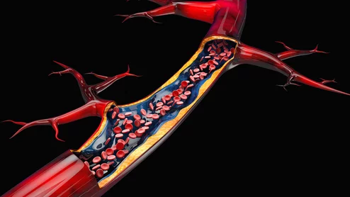 blood clot flow artery thrombectomy 