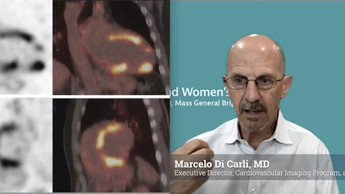 Nuclear cardiology is entering a new era—one that goes well beyond the traditional focus on myocardial perfusion imaging. According to Marcelo Di Carli, MD, editor-in-chief of the Journal of Nuclear Cardiology and chief of the Division of Nuclear Medicine at Brigham and Women’s Hospital, the field is rapidly expanding into diagnosing and monitoring complex cardiac diseases such as amyloidosis, sarcoidosis, myocarditis, and cardiac infections.