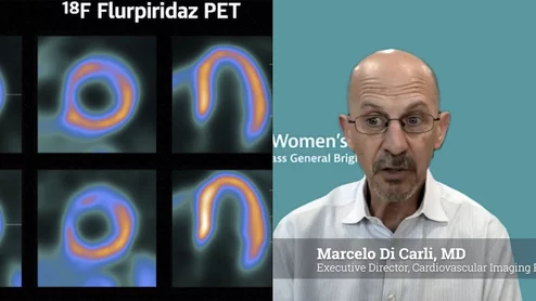 Marcelo Di Carli, MD, editor-in-Chief of the Journal of Nuclear Cardiology, chief, Division of Nuclear Medicine and Molecular Imaging, Department of Radiology, and executive director, Cardiovascular Imaging Program, at Brigham and Women's Hospital, explains why there is rapid growth of PET imaging because of the extra value it brings in detecting microvascular disease. 