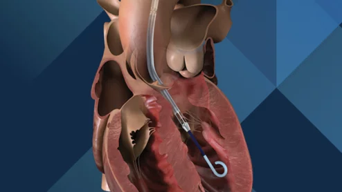 Impella CP Johnson & Johnson MedTech Abiomed