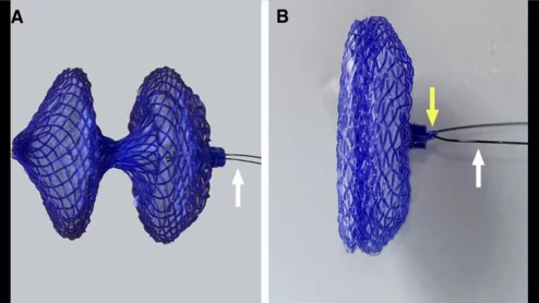 biodegradable PFO closure device
