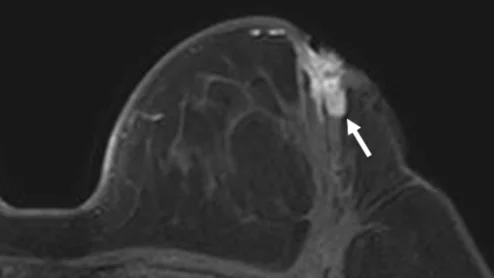 Pre-operative breast MRI improves outcomes in younger women with breast cancer