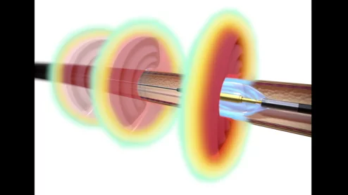 Paradise Ultrasound image courtesy of Recor Medical.