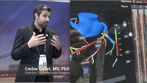Carlos Collet, MD, PhD, director, cardiovascular imaging, physiology and translational therapeutics, Cardiovascular Research Foundation, explains how noninvasive coronary CT angiography (CCTA) assessments will play a major role to eliminate invasive diagnostic angiography and to pre-plan percutaneous coronary intervention (PCI) procedures.
