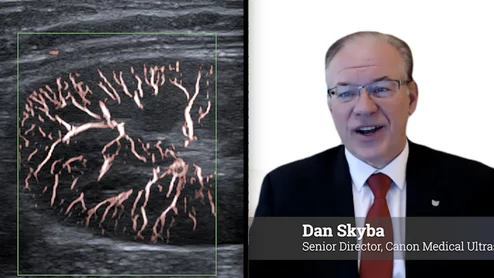 Caon Medical USA ultrasound director Dan Skyba explains advances in ultrasound processing algorithms at RSNA 2025.
