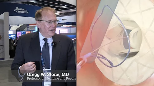 Gregg W. Stone, MD, Director of Academic Affairs for the Mount Sinai Health System and Professor of Medicine (Cardiology) and Professor of Population Health Science and Policy at the Icahn School of Medicine at Mount Sinai, discusses the ATHENS-HF Trial, a first-in-man study of a chronically-adjustbable, bi-atrial pressure sensing inter-atrial shunt from Adona Medical.