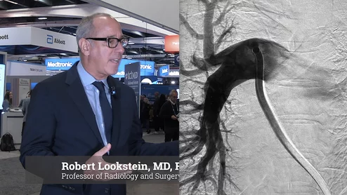 Video Robert Lookstein on mechanical thrombectomy beating anticoagulation alone in pulmonary embolism in the late-breaking STORM-PE trial at TCT 2025.