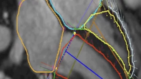 Right ventricle MRI marker independently predicts heart failure