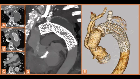 elephant trunk (FET) technique to treat a middle-aged heart patient, sharing their experience in JACC: Case Reports.[1] This is believed to be the first time surgeons have ever employed this particular approach.