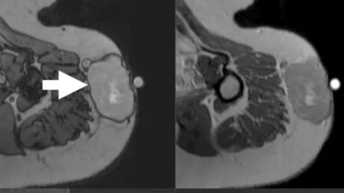 ST-RADS scoring system for predicting risk of soft tissue tumor malignancy