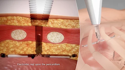 Abbott recently announced it is partnering with AtaCor Medical to develop a next-generation extravascular implantable cardioverter defibrillator (EV-ICD) system. AtaCor's investigational extravascular ICD lead will be paired with Abbott's investigational extravascular ICD system. 