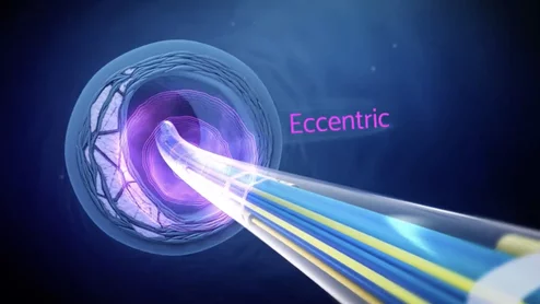 The Boston Scientific Seismiq intravascular lithotripsy (IVL) system entered commercial use in the U.S. in January 2026.