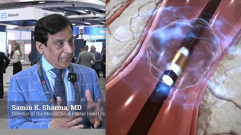 Advances in calcified coronary plaque modification are increasingly centered on intravascular lithotripsy (IVL) because the technology reduces complications such as vessel trauma and perforation associated with traditional high-pressure balloons or atherectomy techniques. Cardiovascular Business spoke with Samin K. Sharma, MD, director of the Mount Sinai Fuster Heart Hospital Cardiovascular Clinical Institute, recently about the advances in IVL. #IVL #TCT
