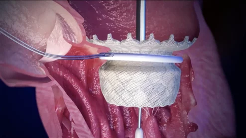 HighLife Transcatheter Mitral Valve Replacement (TMVR) System