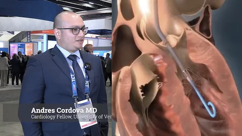 Andres Cordova, MD, cardiology fellow, University of Vermont Medical Center, explains a study of registry and outcomes data on the use of Impella hemodynamic support in elderly STEMI patients with cardiogenic shock.