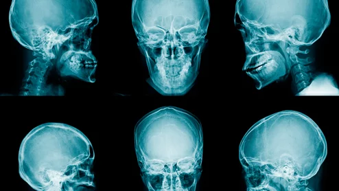 facial x-ray radiograph