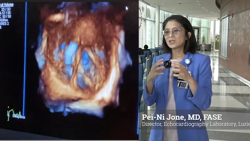 Pei-Ni Jone explains ASE push for 3D TEE in congenital heart