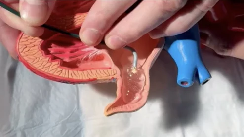 After years of implanting left atrial appendage occlusion (LAAO) devices in atrial fibrillation (AFib) patients, an interventional cardiologist with the University of Chicago Medical Center (UChicago Medicine) has developed a new device that could be a more affordable alternative to Boston Scientific’s Watchman and Abbott’s Amplatzer Amulet LAA Occluder. 