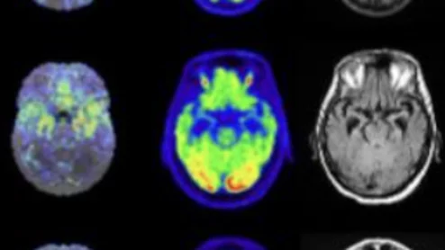 Combining PET and MRI data helps distinguish between LATE and Alzheimer's