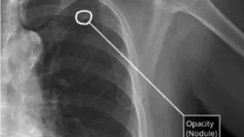 Qure.ai CAD chest X-ray reporting tool cleared by FDA