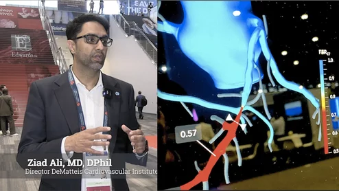 iad Ali, MD, DPhil, director of the DeMatteis Cardiovascular Institute and director investigational interventional cardiology, St. Francis Hospital and Heart Center, explains how coronary computed tomography angiography (CCTA) offers a shift in cardiac care and interventional cardiology because of the information it offers on plaque burden and ischemia based on fractional flow reserve CT (FFR-CT). #TCT #YesCCT