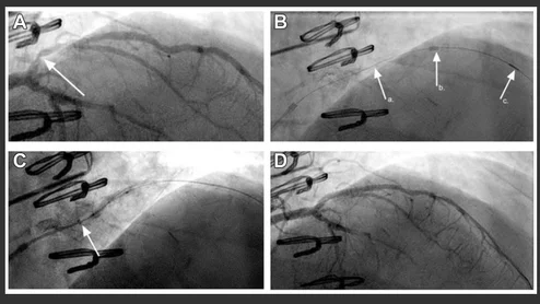 Angiography demonstrates a high-grade, modestly angulated stenosis (arrow) in the proximal segment of a large diagonal branch (A). Predilation performed with difficulty, and the GEC could not be advanced beyond stenosis even with “inch worming” techniques. (B). Advancement of the CrossFAST (C) beyond the proximal stent edge stenosis (a.), the position of the distal end of the outer catheter (b.), and the microcatheter tip (c.) are indicated.