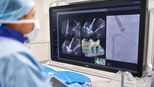 Philips has secured U.S. Food and Drug Administration (FDA) clearance for EchoNavigator R5.0 with DeviceGuide, the company’s artificial intelligence (AI)-enabled software for mitral transcatheter edge-to-edge repair (M-TEER). 