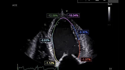 Ligence Heart is a recently FDA cleared AI that fully automates analyses, measurements and reporting for transthoracic echo.