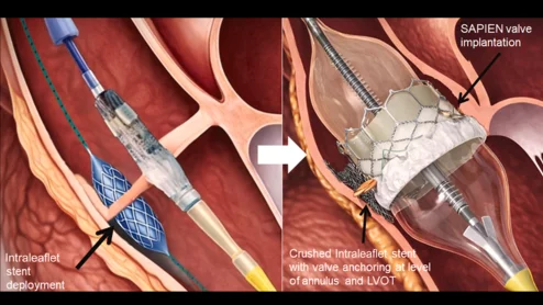After traversing the aortic cusp with an electrified wire and balloon inflation, a stent is positioned inside the noncoronary cusp and deployed. Immediately after, a transcatheter aortic valve is expanded, and the stent is crushed on the left ventricular outflow tract wall and annulus, while anchored to the aortic valve leaflet. 