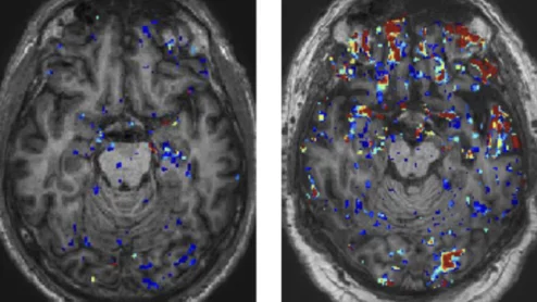'Leaky' blood brain barrier causes long-term damage years after head injuries