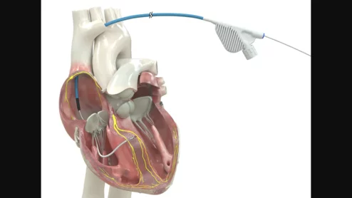 OmniaSecure defibrillation lead approved by FDA for placement in LBB area