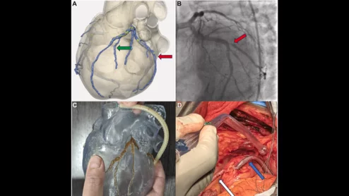 Vascudyne's off-the-shelf conduit for CABG surgeries