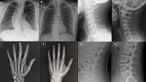 Deepfake X-rays trick radiologists and AI