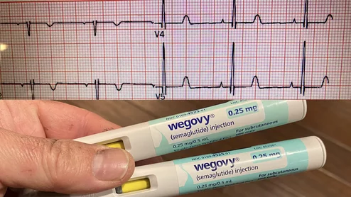 GLP-1 receptor agonists (GLP-1-RAs) have become the wonder drug not only of weight loss, but also for improving cardiovascular health in a growing number of positive cardiovascular trials. The latest study of more than 13,000 patients presented at Heart Rhythm 2026 this week showed the GLP-1 reduce atrial fibrillation (AFib) and survival, even after accounting for the drug’s impact on weight loss. 