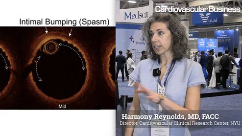 Harmony Reynolds, MD, FACC, director of the cardiovascular clinical research center at NYU Langone Health, presented a study at the American College of Cardiology (ACC) 2026 meeting using coronary optical coherence tomography (OCT) and cardiac magnetic resonance imaging (MRI) to determine sex differences in underlying causes of myocardial infarction with no obstructive coronary arteries (MINOCA).