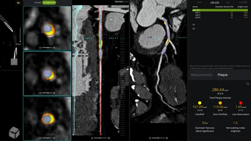 cvi42 | Plaque Circle Cardiovascular Imaging