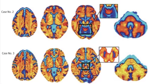 Neuropacs for Parkinsonian syndromes